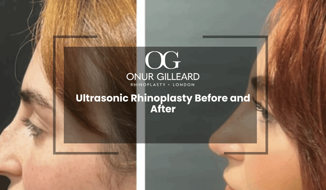 Ultrasonic Rhinoplasty Before and After