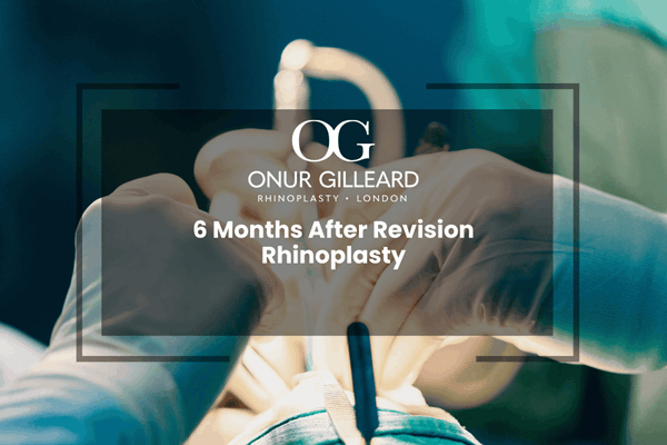 6 Months After Revision Rhinoplasty