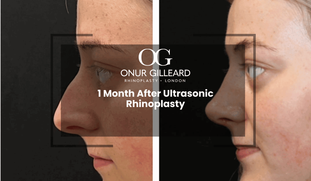 1 Month After Ultrasonic Rhinoplasty