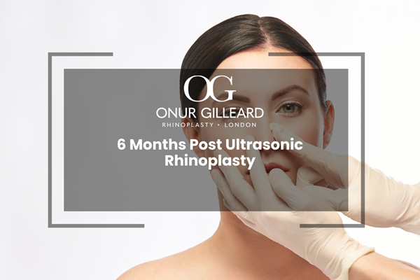 6 Months Post Ultrasonic Rhinoplasty