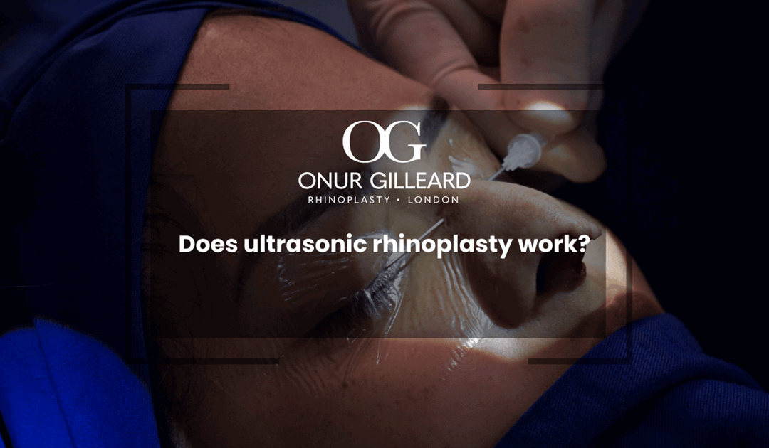 Does ultrasonic rhinoplasty work?