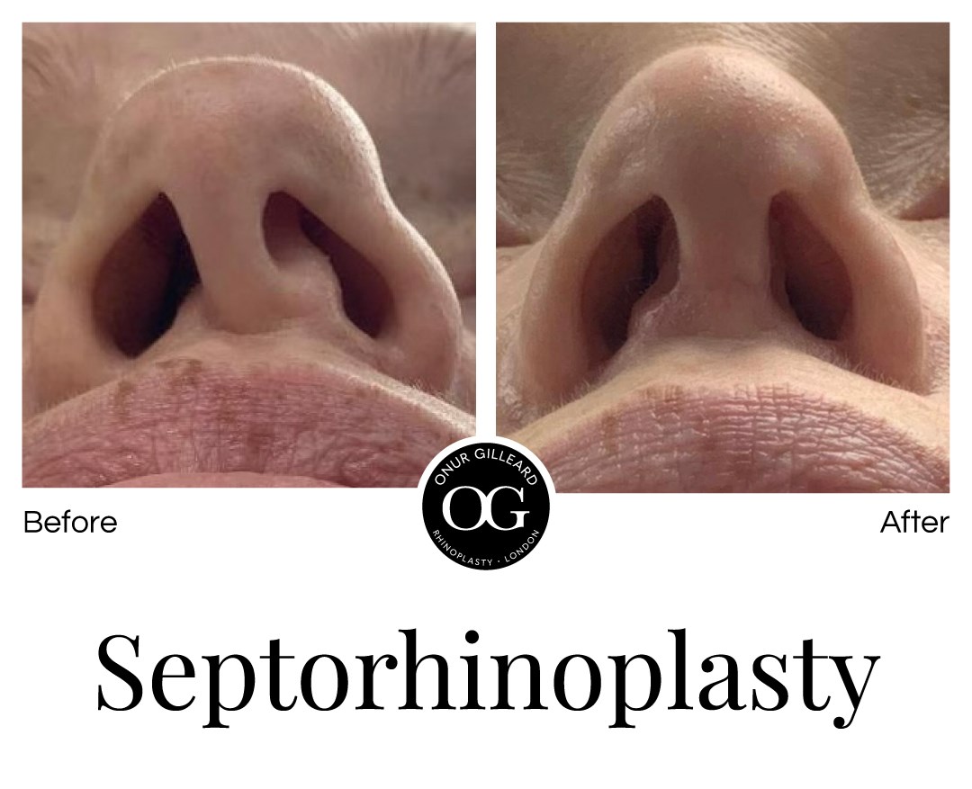 What is Septorhinoplasty?